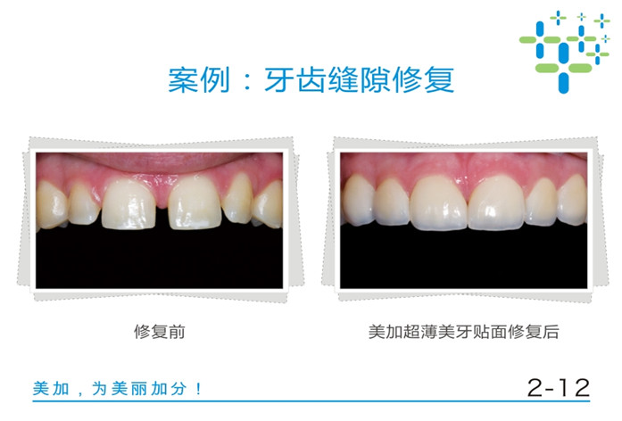 牙齿缝隙修复