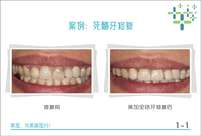 死髓牙修复