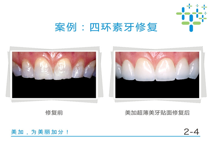 四环素牙修复