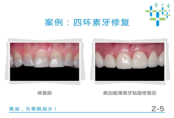 树脂贴面与全瓷贴面的对比修复