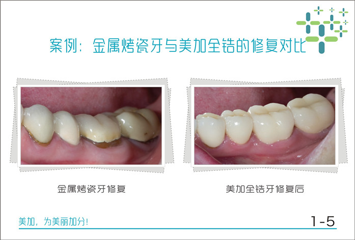 金属烤瓷牙与美加全锆的修复对比