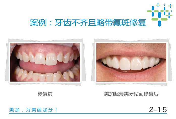 牙齿不齐且略带氟斑修复