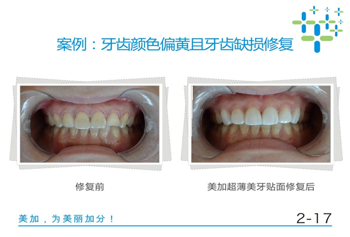 牙齿颜色偏黄且牙齿缺损修复