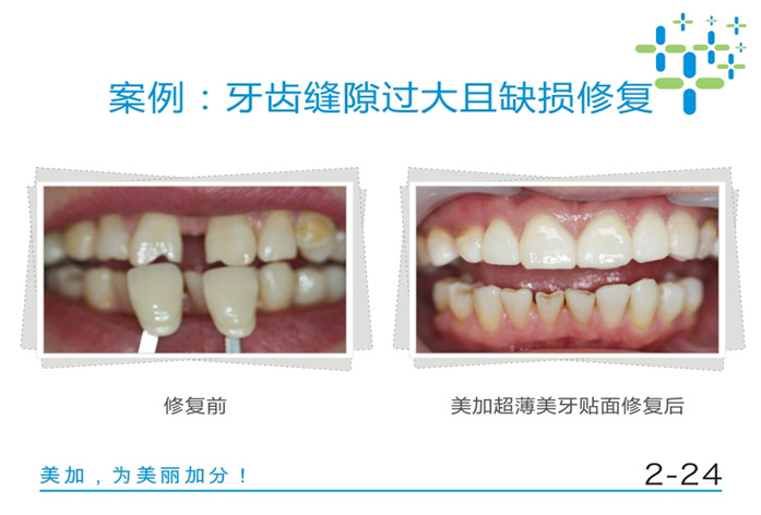 牙齿缝隙过大且缺损修复
