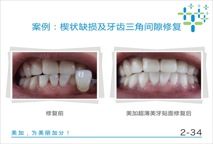 楔状缺损及牙齿三角间隙修复