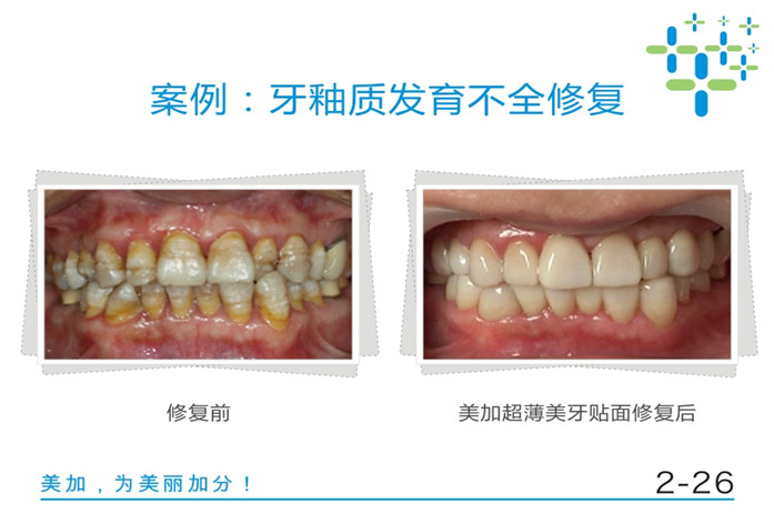 牙釉质发育不全修复