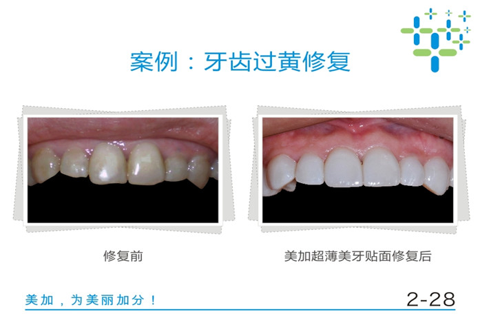 牙齿过黄修复