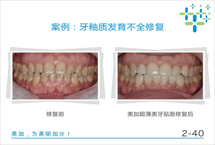 牙釉质发育不全修复