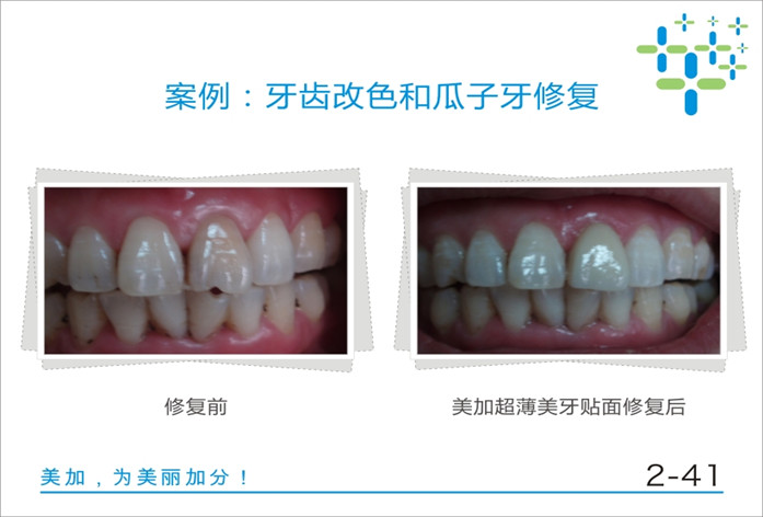 牙齿改色和瓜子牙修复