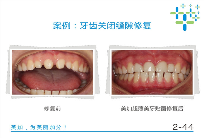牙齿关闭缝隙修复