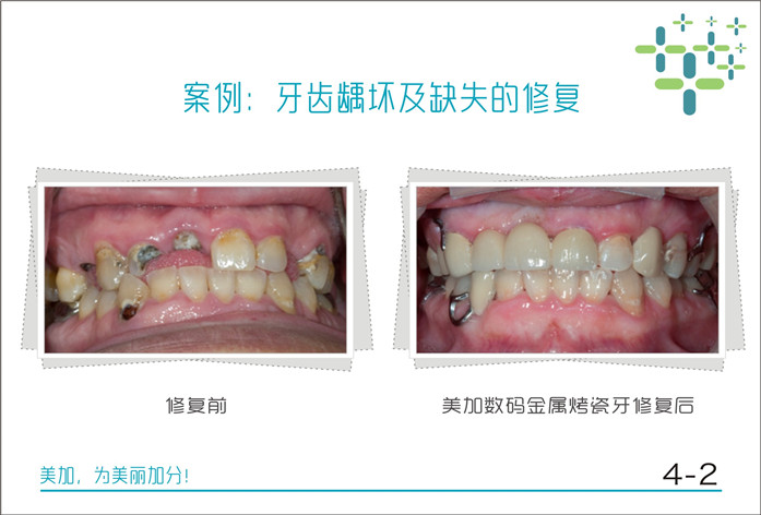 牙齿龋坏及缺失的修复