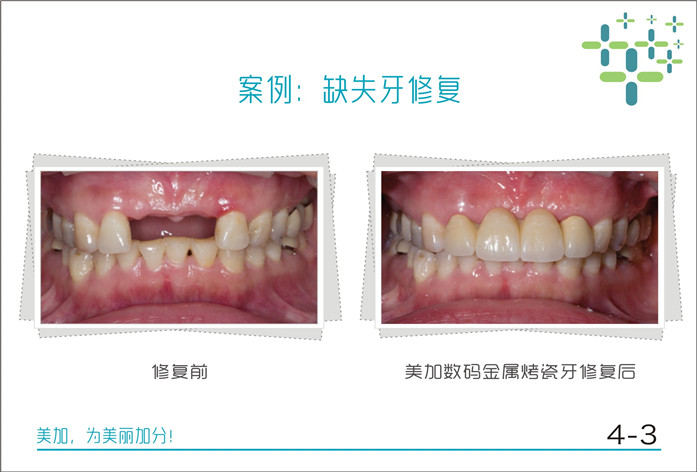 缺失牙修复